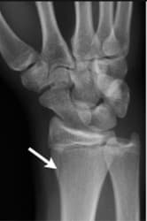 salter harris 2 fracture x-ray image