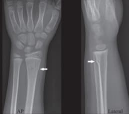 classic torus fracture x-ray image